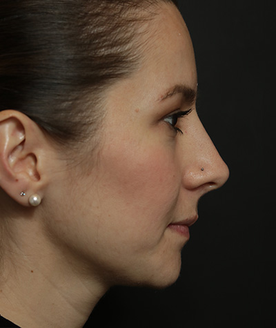 Fillers After Photo #4