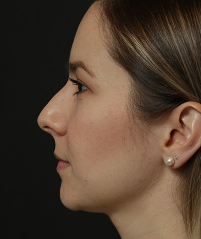 Fillers Before Photo #5