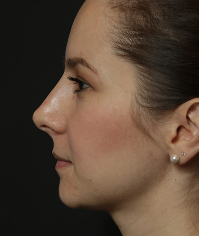 Fillers After Photo #6