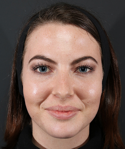 Fillers After Photo #2