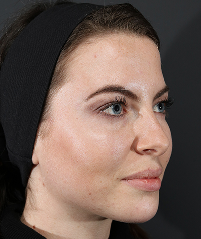 Fillers After Photo #4