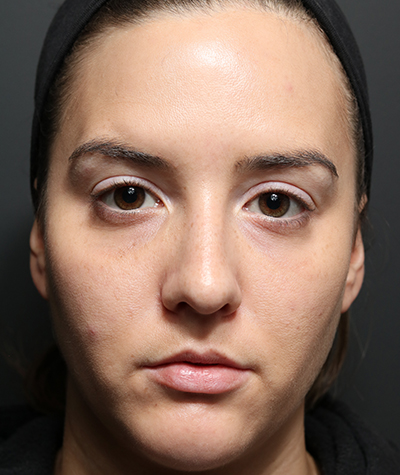 Fillers After Photo #2