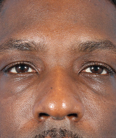 Fillers Before Photo #1