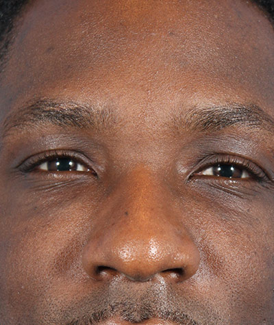 Fillers After Photo #2