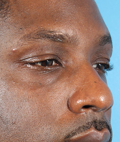 Fillers Before Photo #3