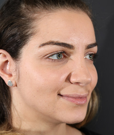 Ethnic Rhinoplasty After Photo #2