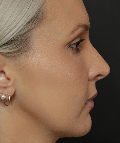 Female Rhinoplasty After Photo #6