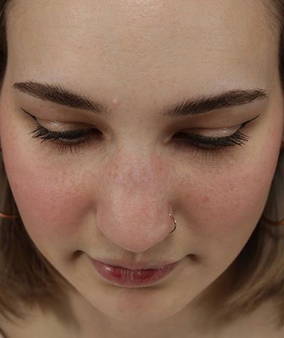 Female Rhinoplasty Before Photo #11
