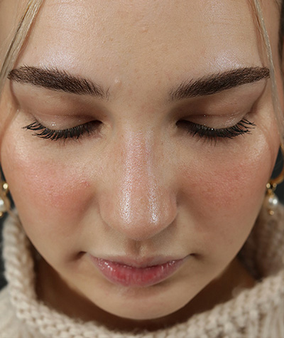 Female Rhinoplasty After Photo #12