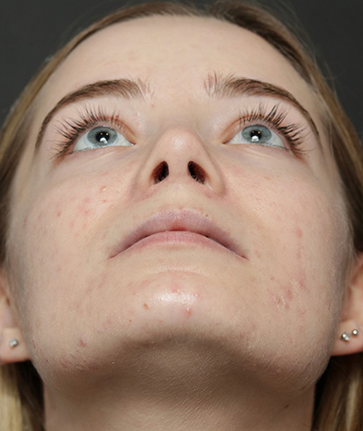 Female Rhinoplasty After Photo #10