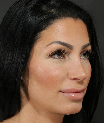 Female Rhinoplasty After Photo #4