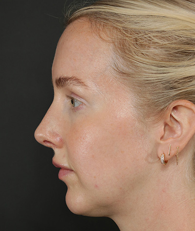 Female Rhinoplasty After Photo #10