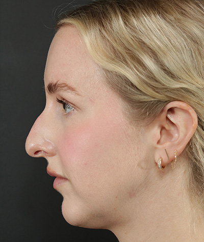 Female Rhinoplasty Before Photo #9