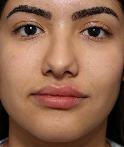 Female Rhinoplasty Before Photo #1