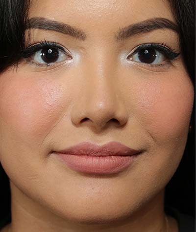 Female Rhinoplasty After Photo #2