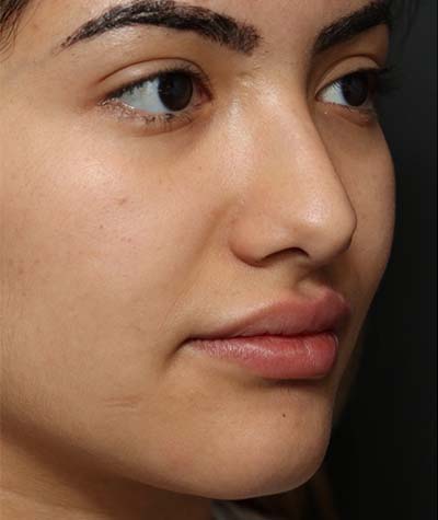 Female Rhinoplasty Before Photo #3