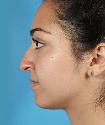 Female Rhinoplasty Before Photo #3