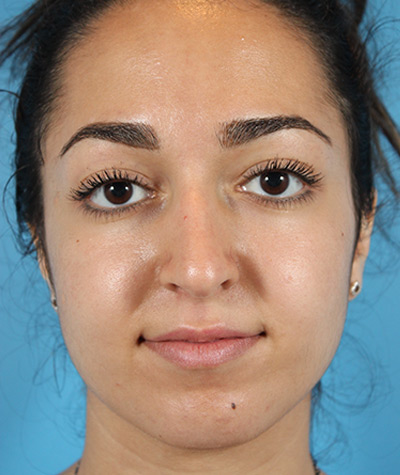 Female Rhinoplasty Before Photo #5
