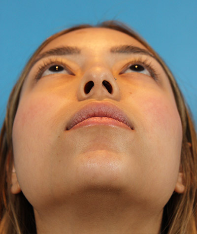 Female Rhinoplasty Before Photo #7
