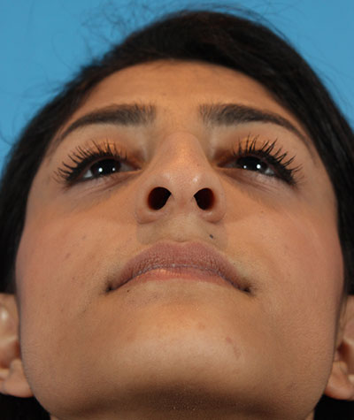 Female Rhinoplasty Before Photo #7