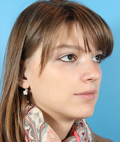 Female Rhinoplasty After Photo #2