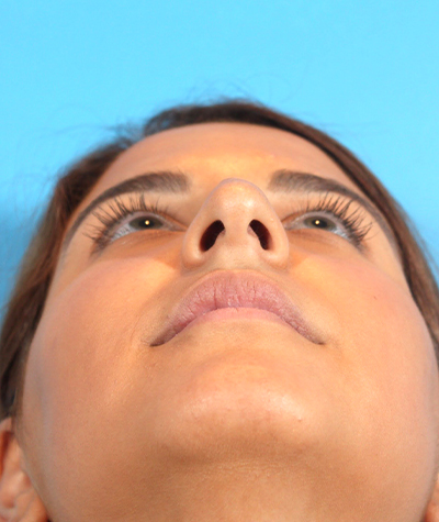 Female Rhinoplasty Before Photo #7