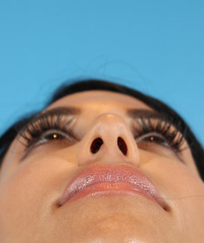 Female Rhinoplasty Before Photo #7
