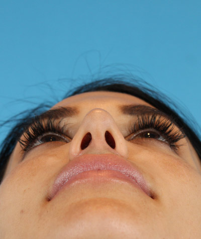 Female Rhinoplasty After Photo #8