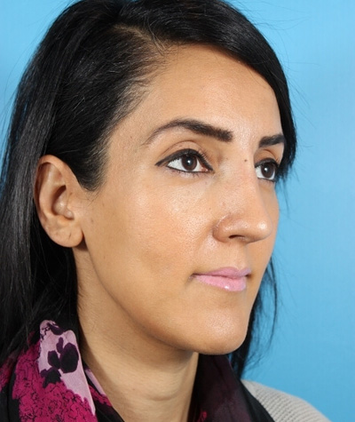 Female Rhinoplasty After Photo #2