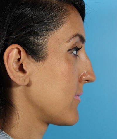 Female Rhinoplasty Before Photo #3