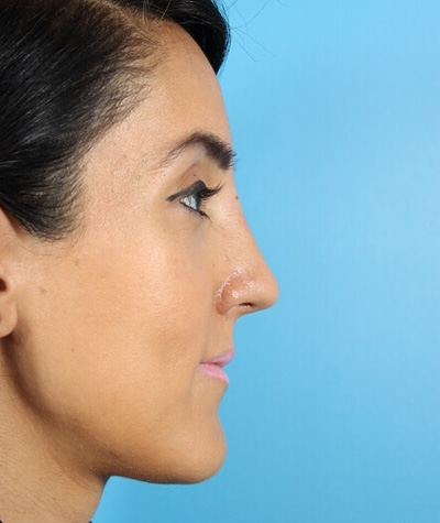 Female Rhinoplasty After Photo #4