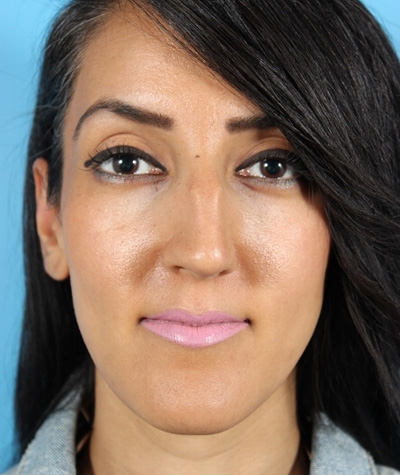 Female Rhinoplasty Before Photo #5