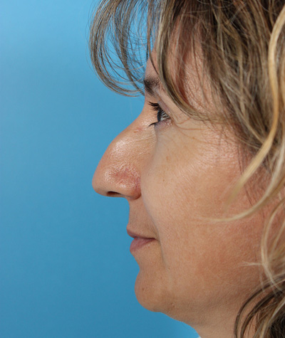 Female Rhinoplasty Before Photo #7