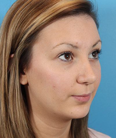 Female Rhinoplasty After Photo #2