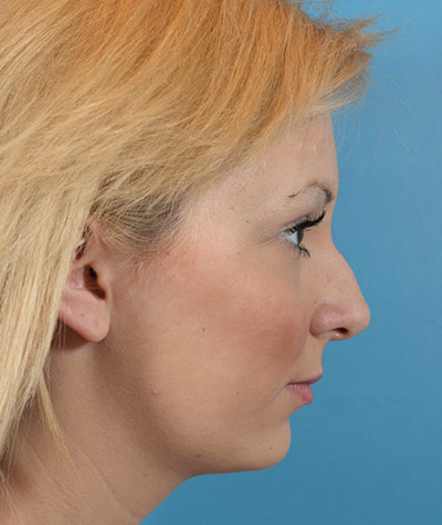 Female Rhinoplasty Before Photo #3