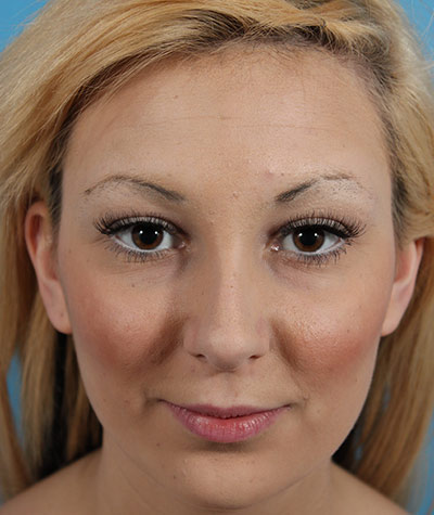 Female Rhinoplasty Before Photo #5