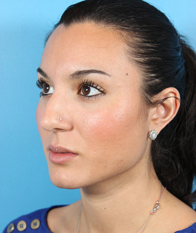 Female Rhinoplasty Before Photo #1