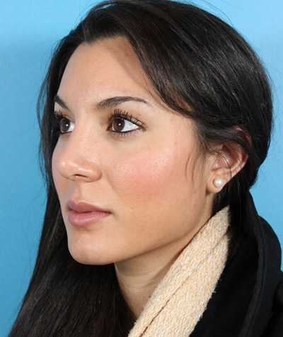 Female Rhinoplasty After Photo #2