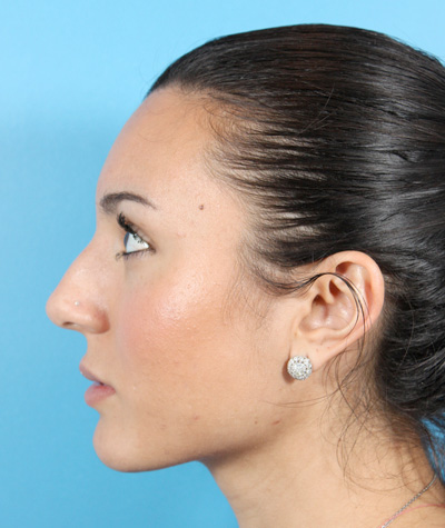 Female Rhinoplasty Before Photo #3
