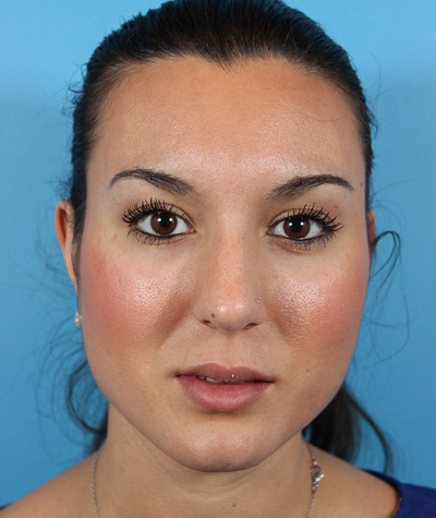Female Rhinoplasty Before Photo #5