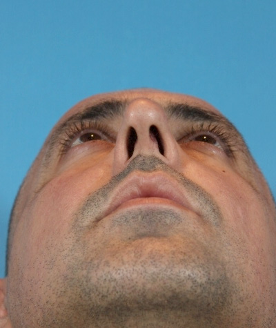 Male Rhinoplasty Before Photo #5