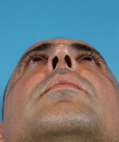 Male Rhinoplasty After Photo #6