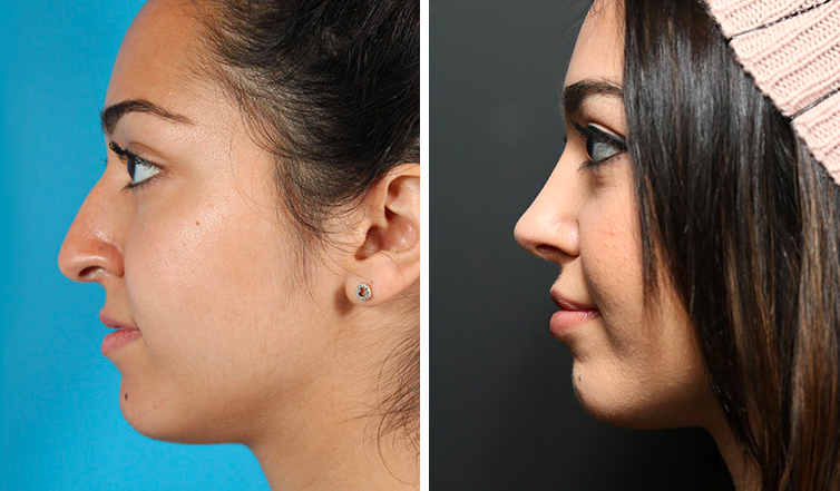 Rhinoplasty Toronto | Nose Job Cost Ontario - Dr. Asaria