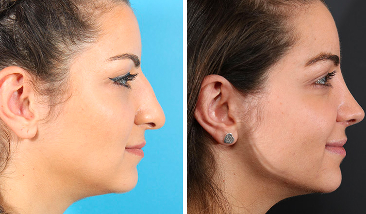 Complete procedure of nose surgery- Rhinoplasty in Toronto