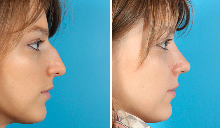 Rhinoplasty Toronto Nose Job Cost Ontario Dr Asaria