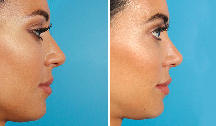 how much is a non surgical nose job in canada