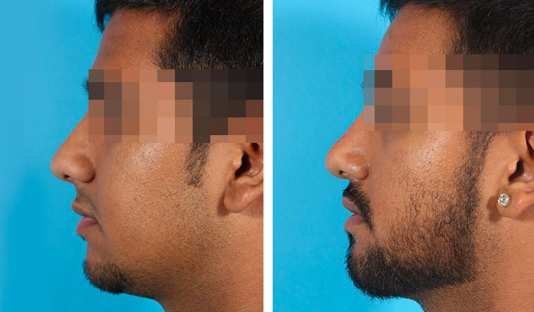Male Rhinoplasty Picture